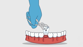 How Should I Recognize I Need Emergency Tooth Extraction?