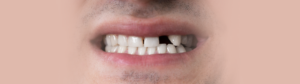 Image of a smile with a knocked out tooth. Knocked out teeth are one of the most common issues our emergency dentist sees at Torbay Smiles Dentistry.