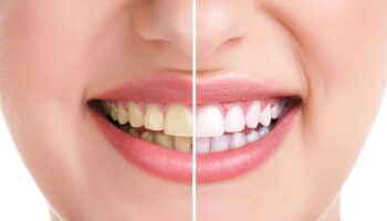 7 Myths About Teeth Whitening Debunked