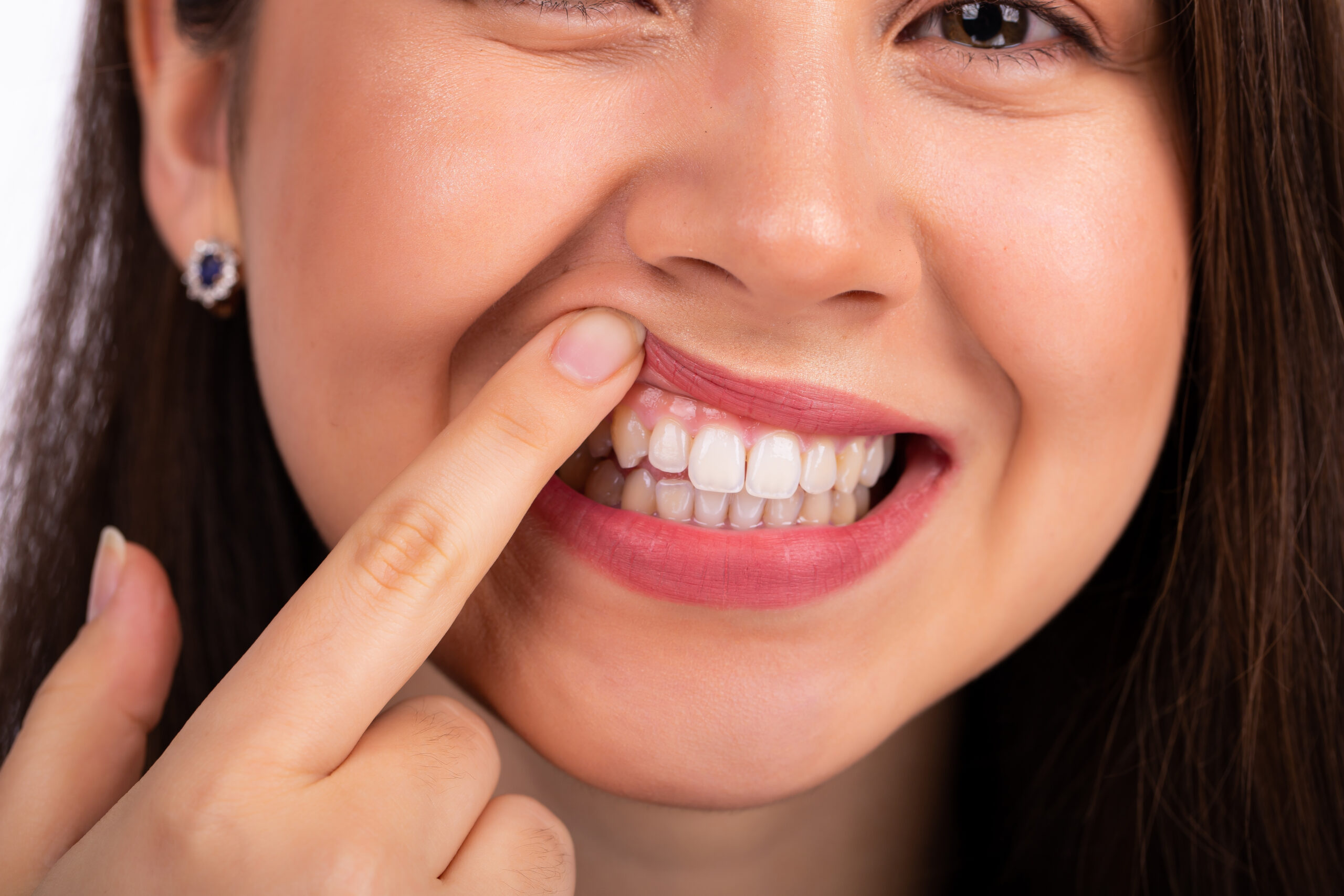 6 Critical Daily Habits to Prevent Receding Gums