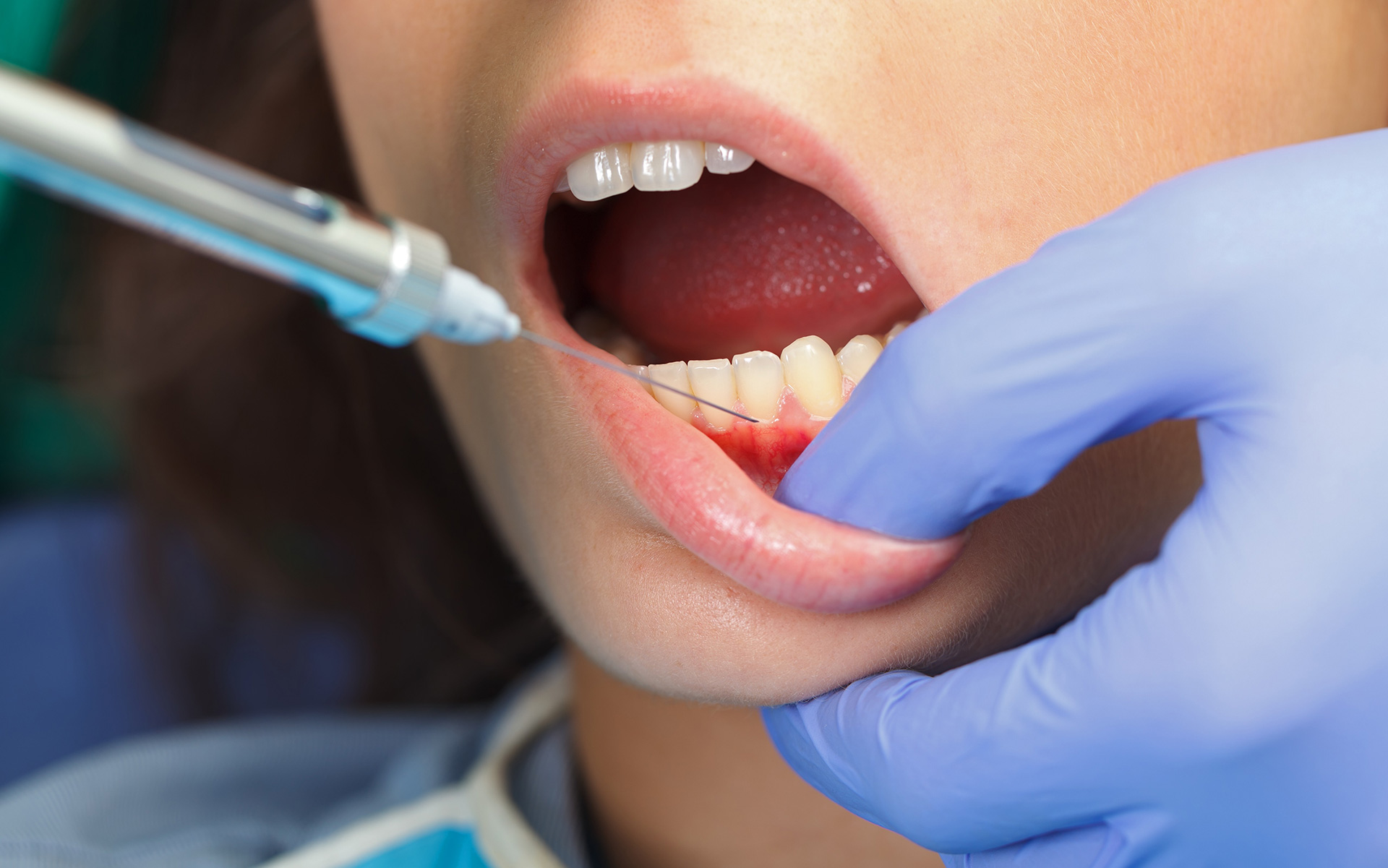 IV Sedation Dentistry in Brandon: A Safe Solution for Adults with Dental Anxiety